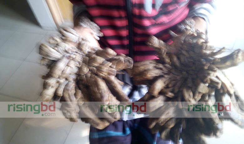 Govt assures `tree man` Abul of all medical costs